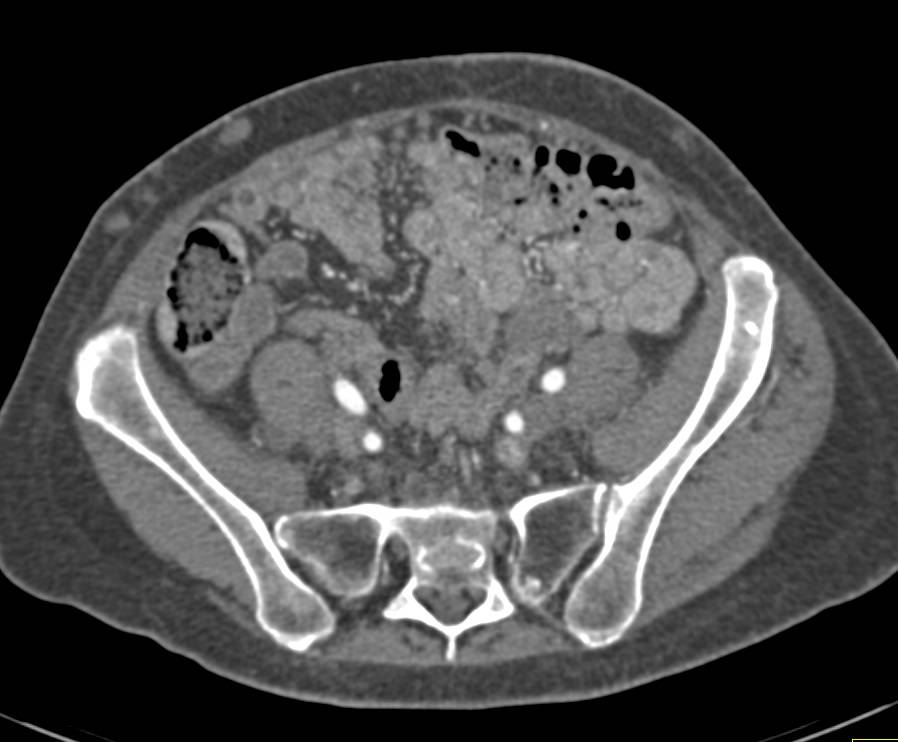 Recurrent Renal Carcinoma in the Left Psoas Muscle with Adenopathy and Bone Metastases - CTisus CT Scan