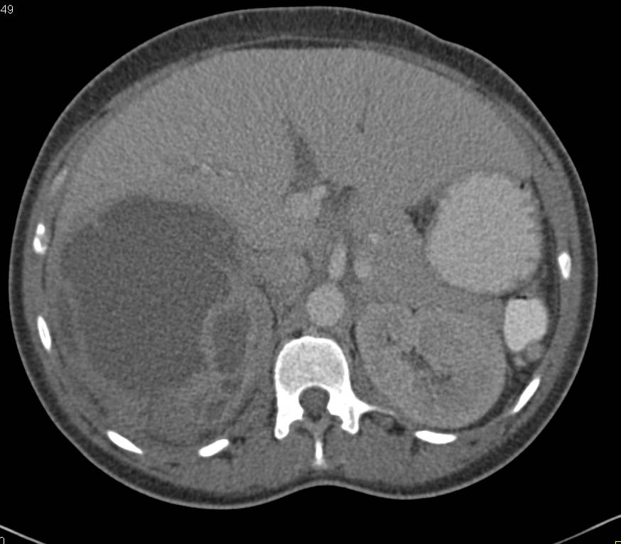 XGP (Xanthogranulomatous Pyelonephritis) - CTisus CT Scan