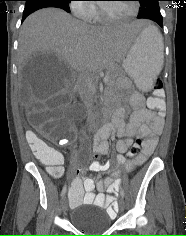 Xanthogranulomatous Pyelonephritis - CTisus CT Scan