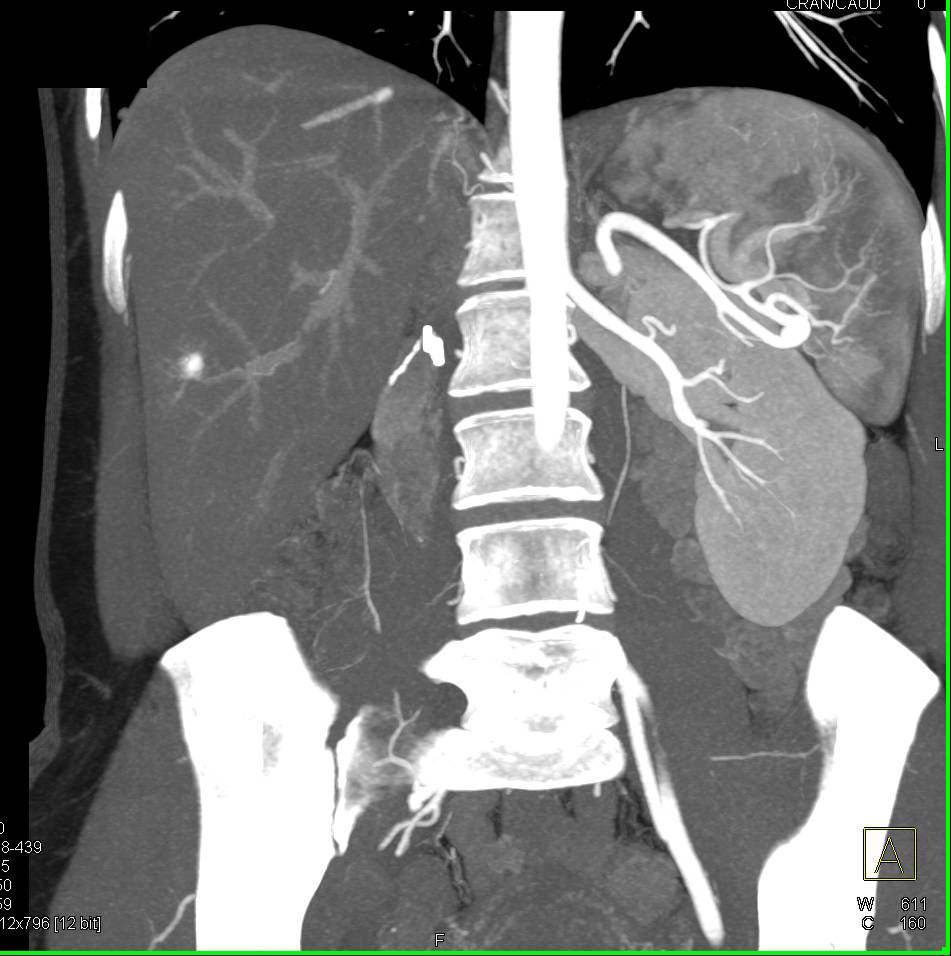 Normal Post Left Nephrectomy Space - CTisus CT Scan