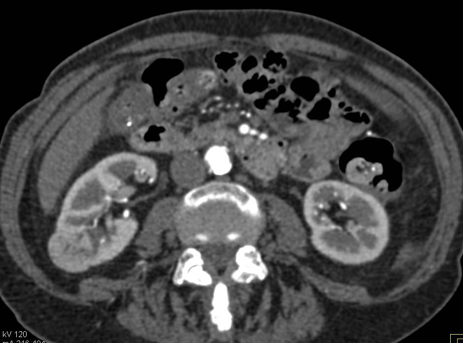 Incidental 2cm Right Renal Cell Carcinoma Papillary Type - CTisus CT Scan