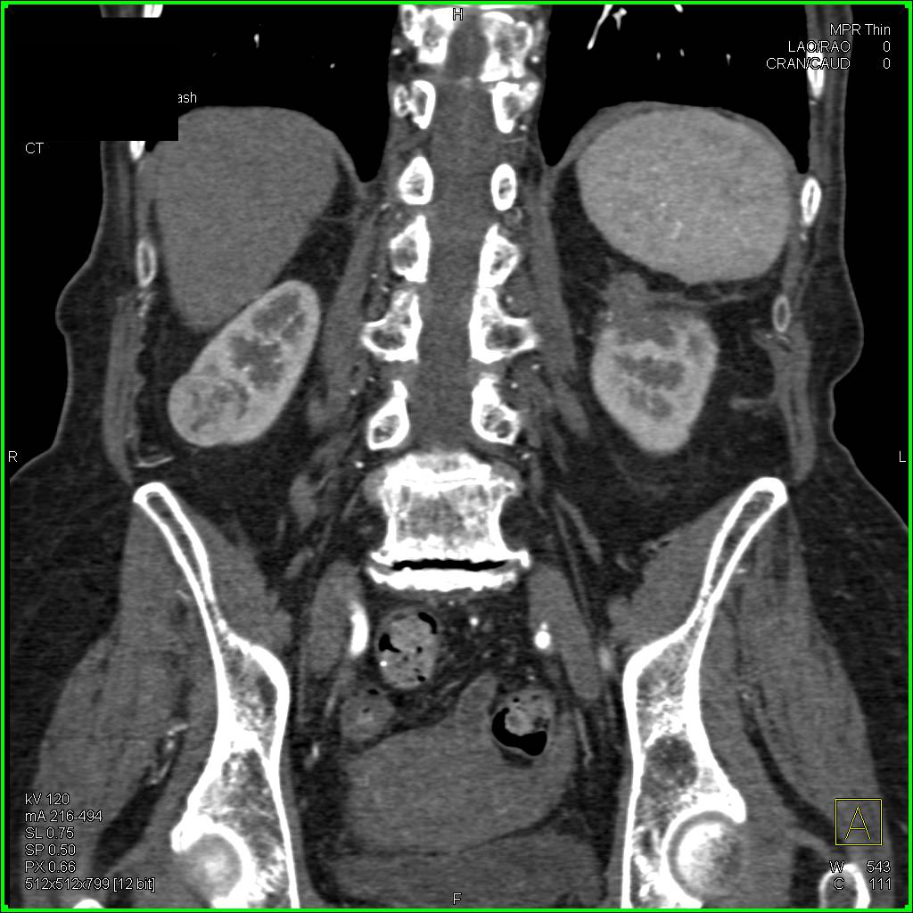 Prior Partial Nephrectomy Upper Pole Left Kidney and Now New Right Renal Cell Carcinoma - CTisus CT Scan