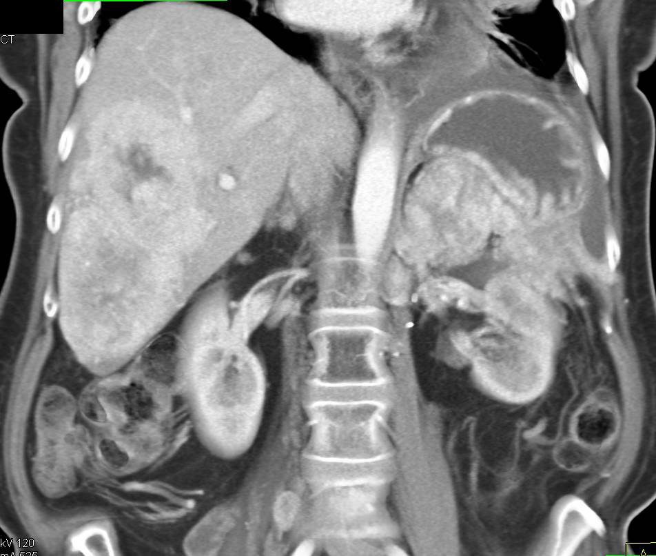 Carcinoid Tumor with Perfusion Changes Left Kidney due to Tumor - CTisus CT Scan