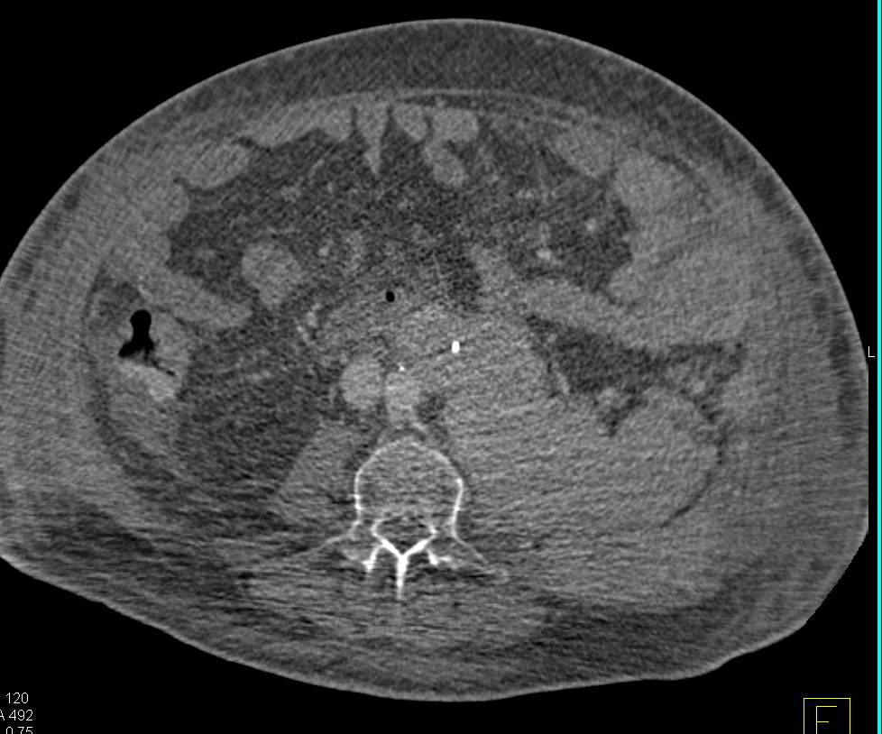 Infiltrating Left Renal Lymphoma - CTisus CT Scan