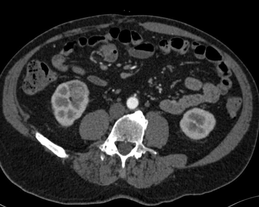 Subtle Right Renal Cell Carcinoma - CTisus CT Scan