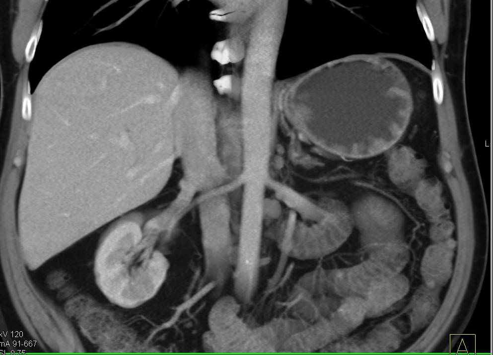 Incidental Right Renal Cell Carcinoma - CTisus CT Scan