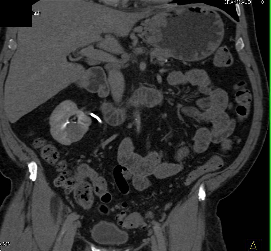 Papillary Renal Cell Carcinoma Right Kidney - CTisus CT Scan