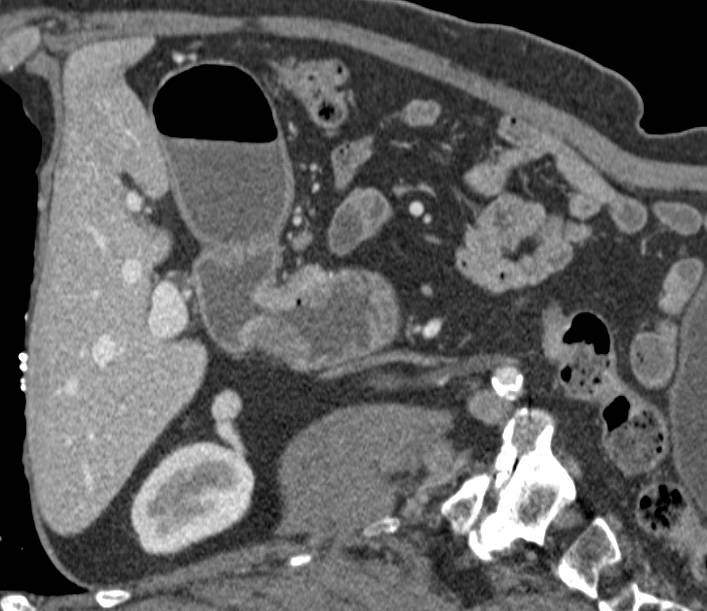 2 Cm Ampullary Carcinoma - CTisus CT Scan