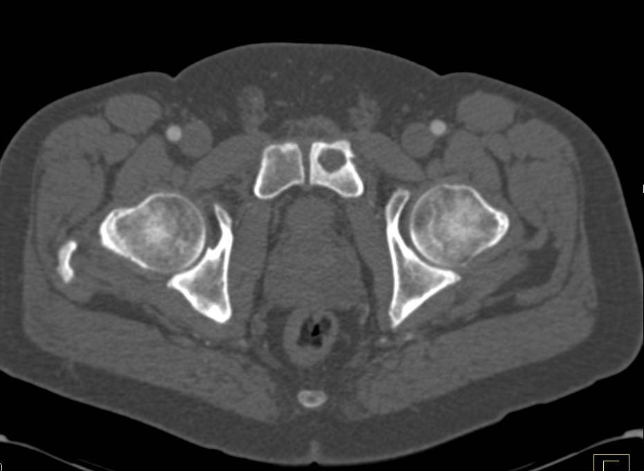 Simple Cyst with Bone Remodeling - CTisus CT Scan