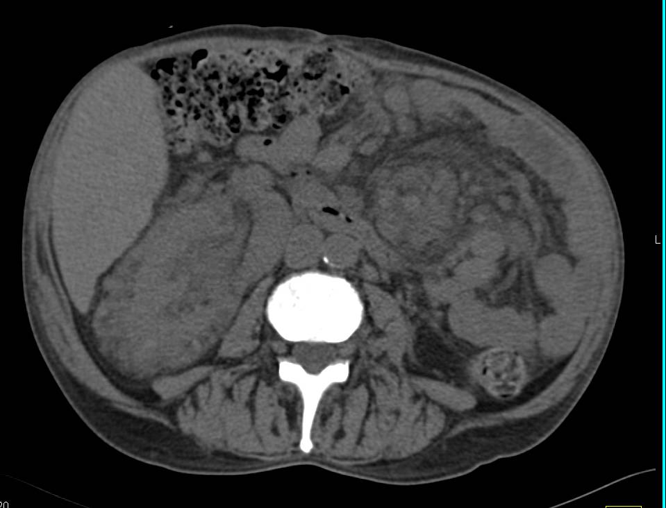 Erdheim Chester Disease with Renal Involvement - CTisus CT Scan