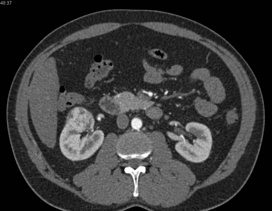 Renal Cell carcinoma Right Kidney on Multiple Phases - CTisus CT Scan