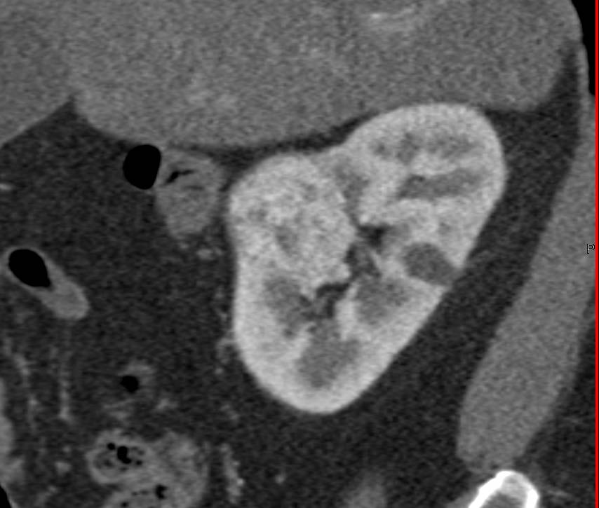 Papillary Renal Cell Carcinoma - CTisus CT Scan