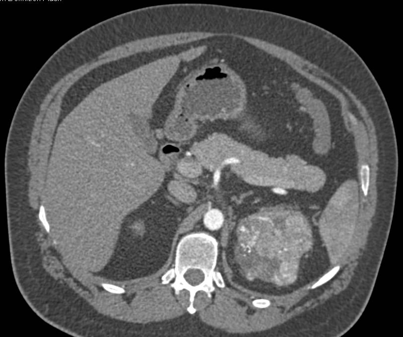 Renal Cell Carcinoma - CTisus CT Scan