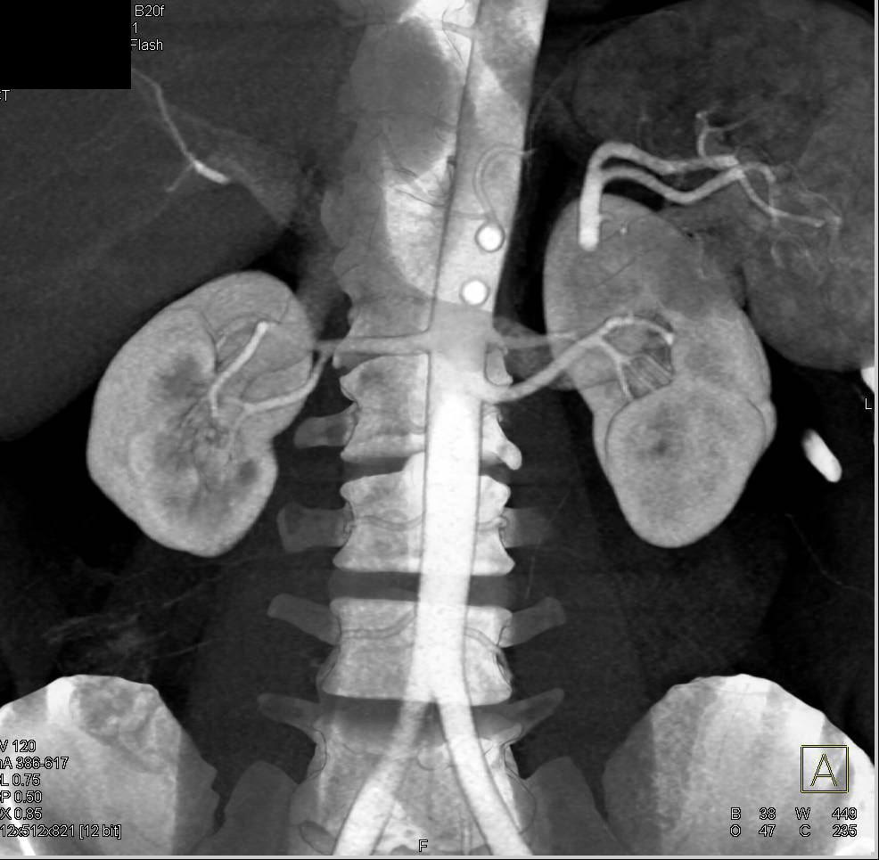 Renal Donor with Two Left Renal Arteries - CTisus CT Scan