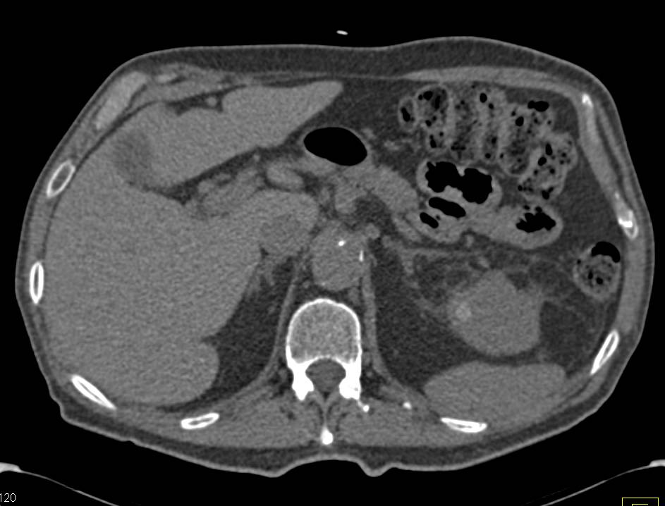 Large Clear Cell Renal Cell Carcinoma Left Kidney - CTisus CT Scan