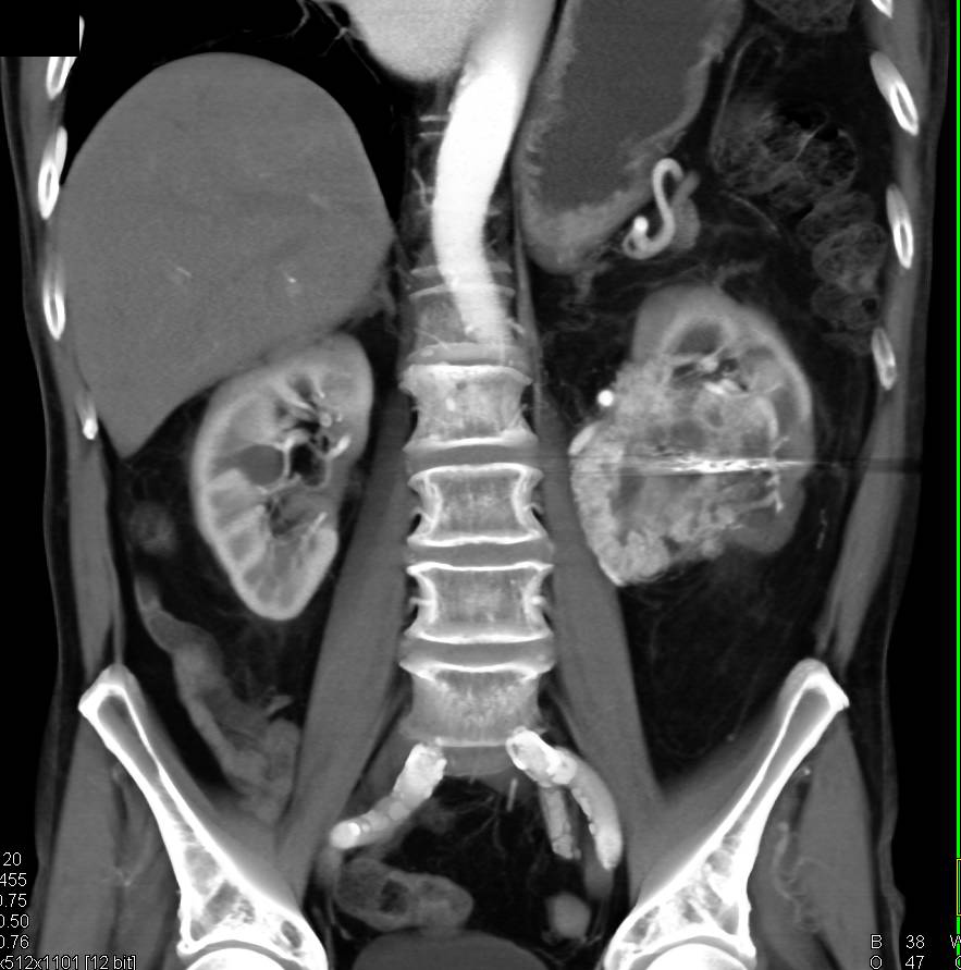 Clear Cell Renal Cell Carcinoma s/p Embolization - CTisus CT Scan