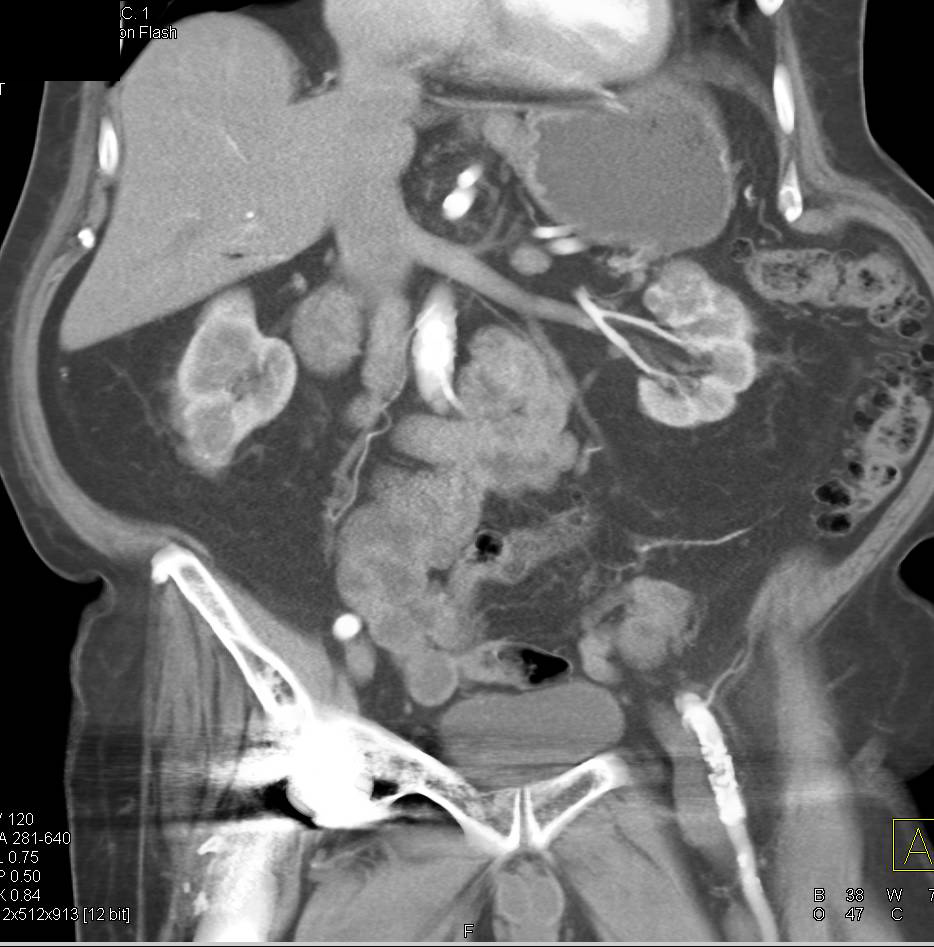 Numerous Cystic Renal Lesions Several of Concern for Malignancy - CTisus CT Scan