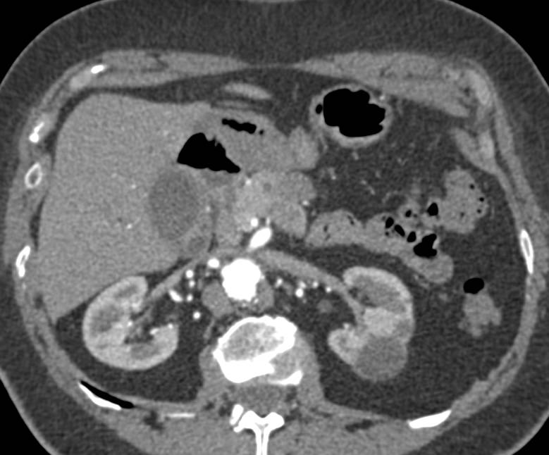 Complex Renal Cyst - CTisus CT Scan