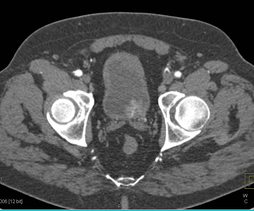 Incidental Bladder Cancer near Left Ureterovesical Junction (UVJ) - CTisus CT Scan