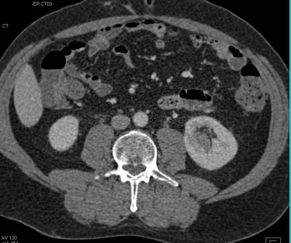 Subtle Transitional Cell Carcinoma Left Kidney - CTisus CT Scan