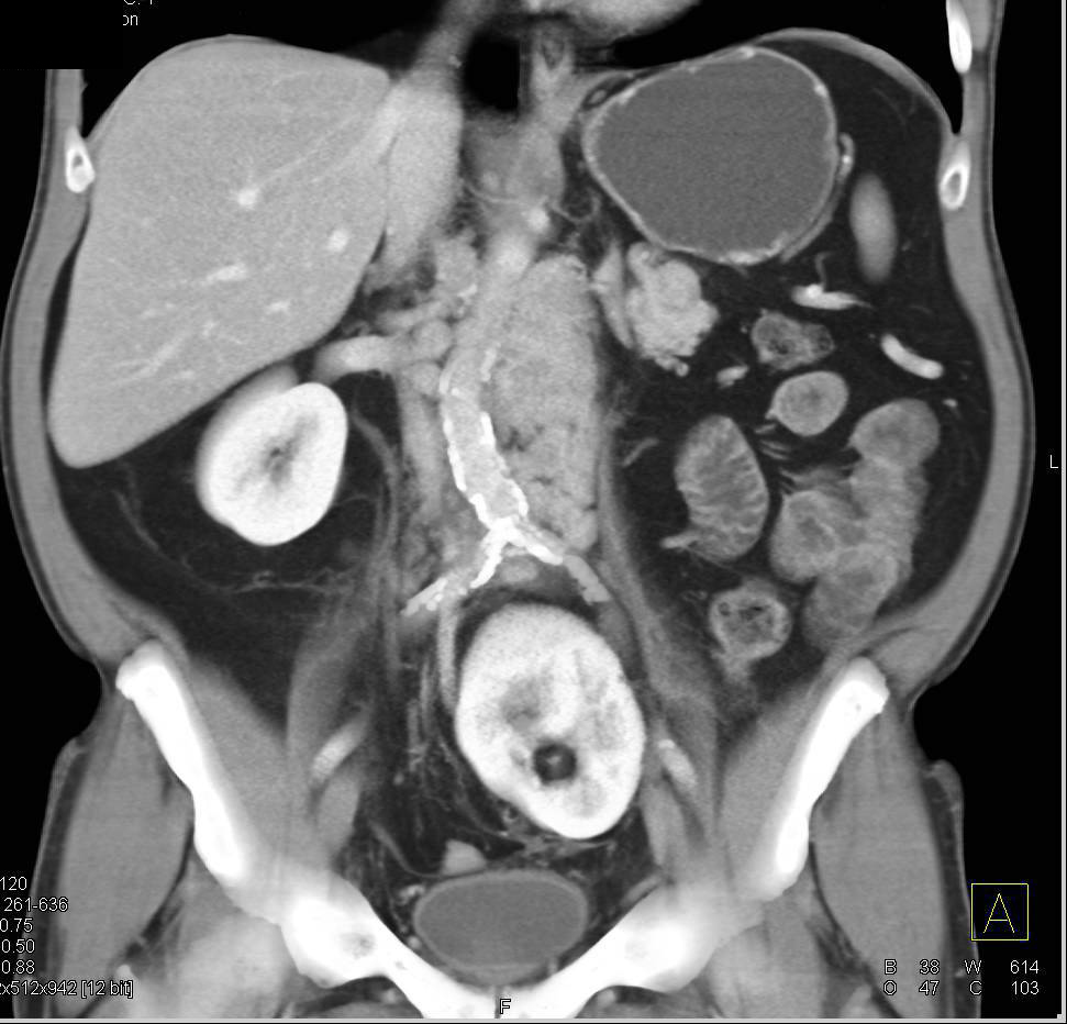 Lymphoma in a Patient with A Pelvic Kidney - CTisus CT Scan
