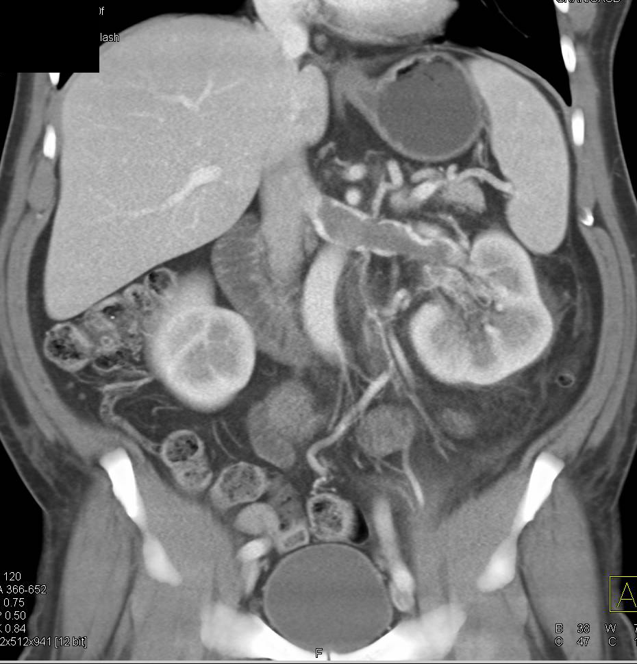 Perirenal Cobwebs in Renal Vein Thrombosis - CTisus CT Scan