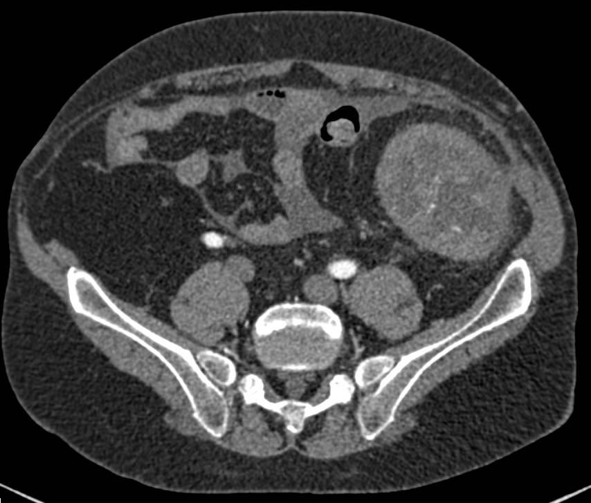 Failed Left Renal Transplant and Enhancing Peritoneum with Ascites - CTisus CT Scan