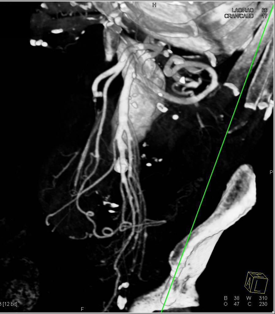 3D Vascular Map of a Pelvic Kidney - CTisus CT Scan