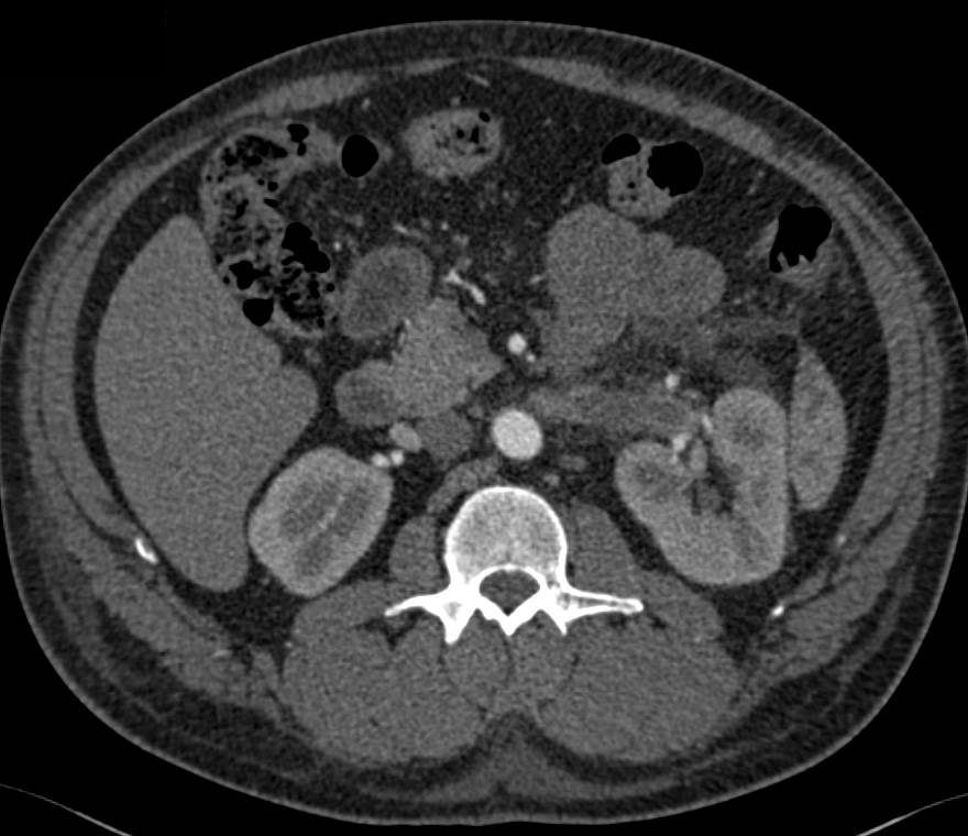 Acute Left Renal Vein Thrombosis - CTisus CT Scan