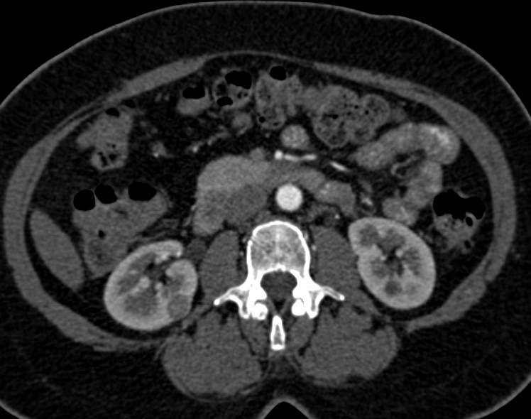 1cm Right Renal Cell Carcinoma-Papillary Type - CTisus CT Scan