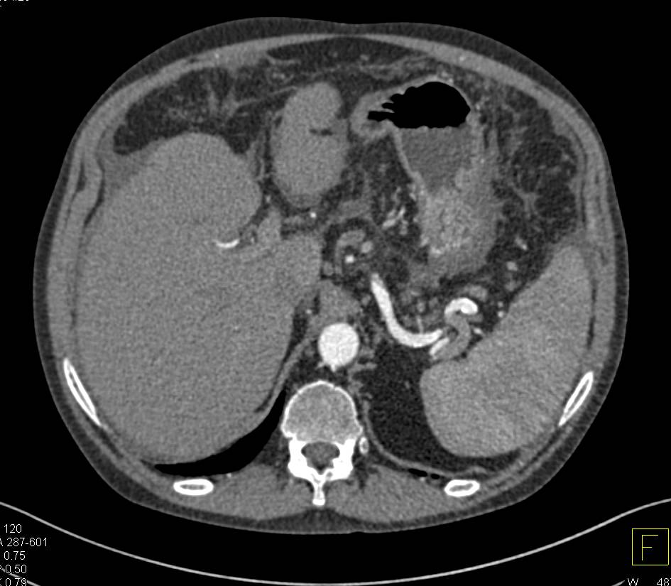 Failing Left Renal Transplant with Small Native Kidneys - CTisus CT Scan