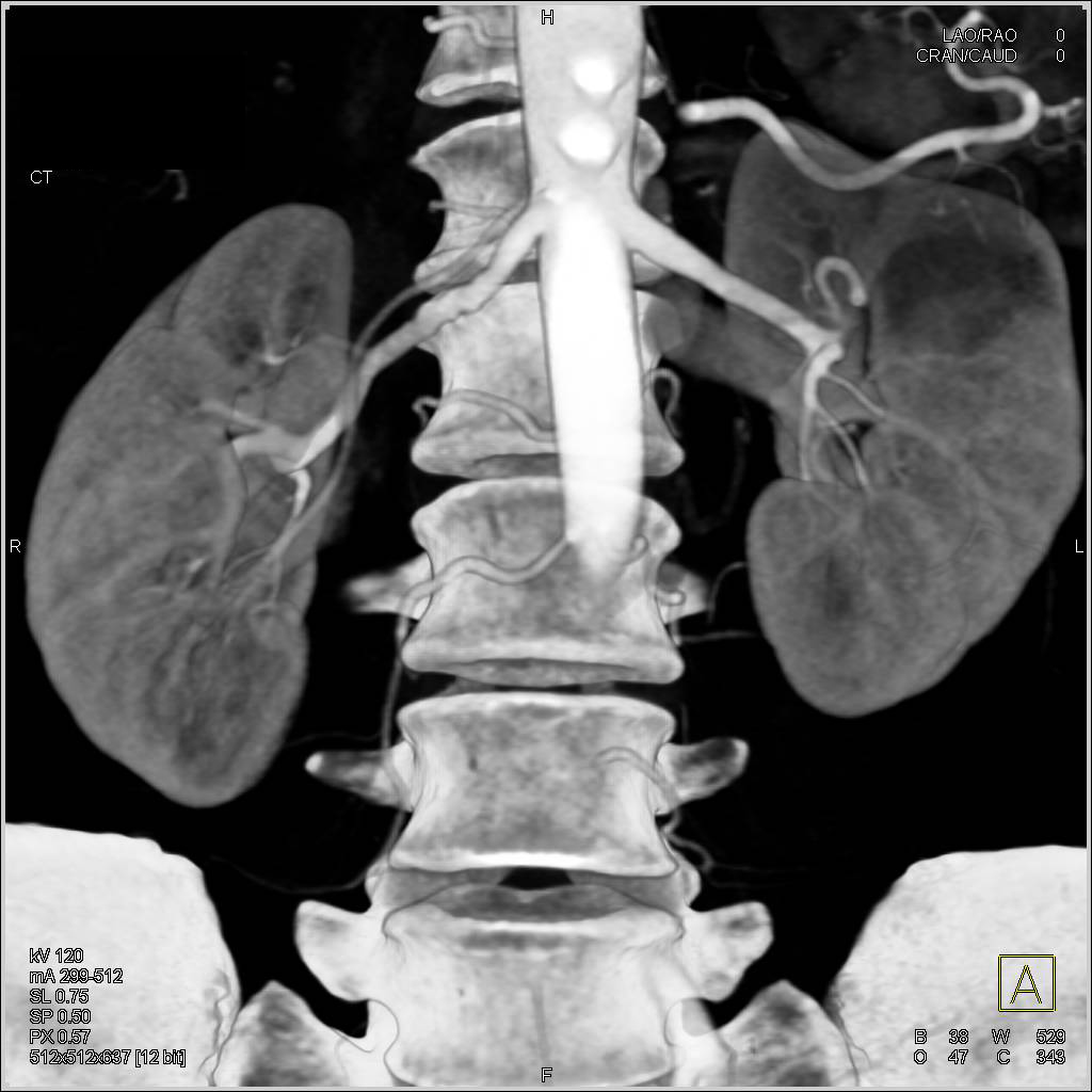 Fibromuscular Dysplasia (FMD) Right Renal Artery - CTisus CT Scan