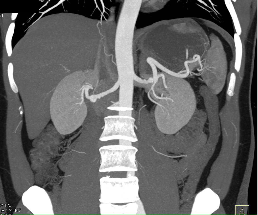 Fibromuscular Dysplasia (FMD) Both Renal Arteries - CTisus CT Scan