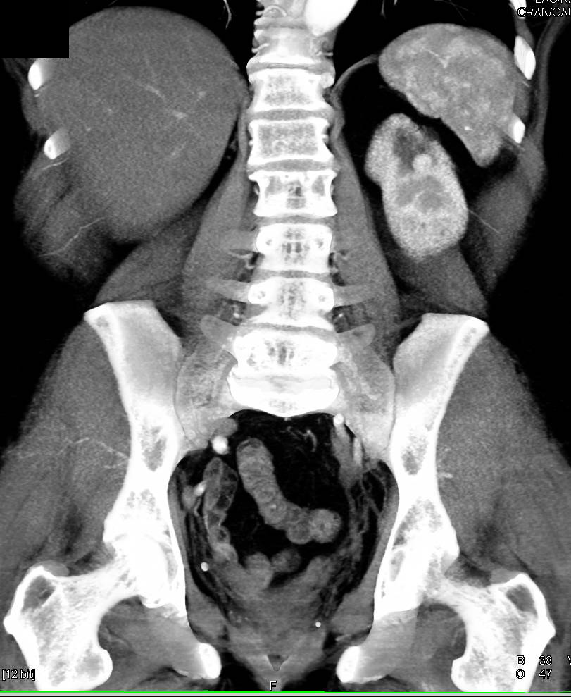 1 cm Recurrence Near Partial Nephrectomy Site - CTisus CT Scan