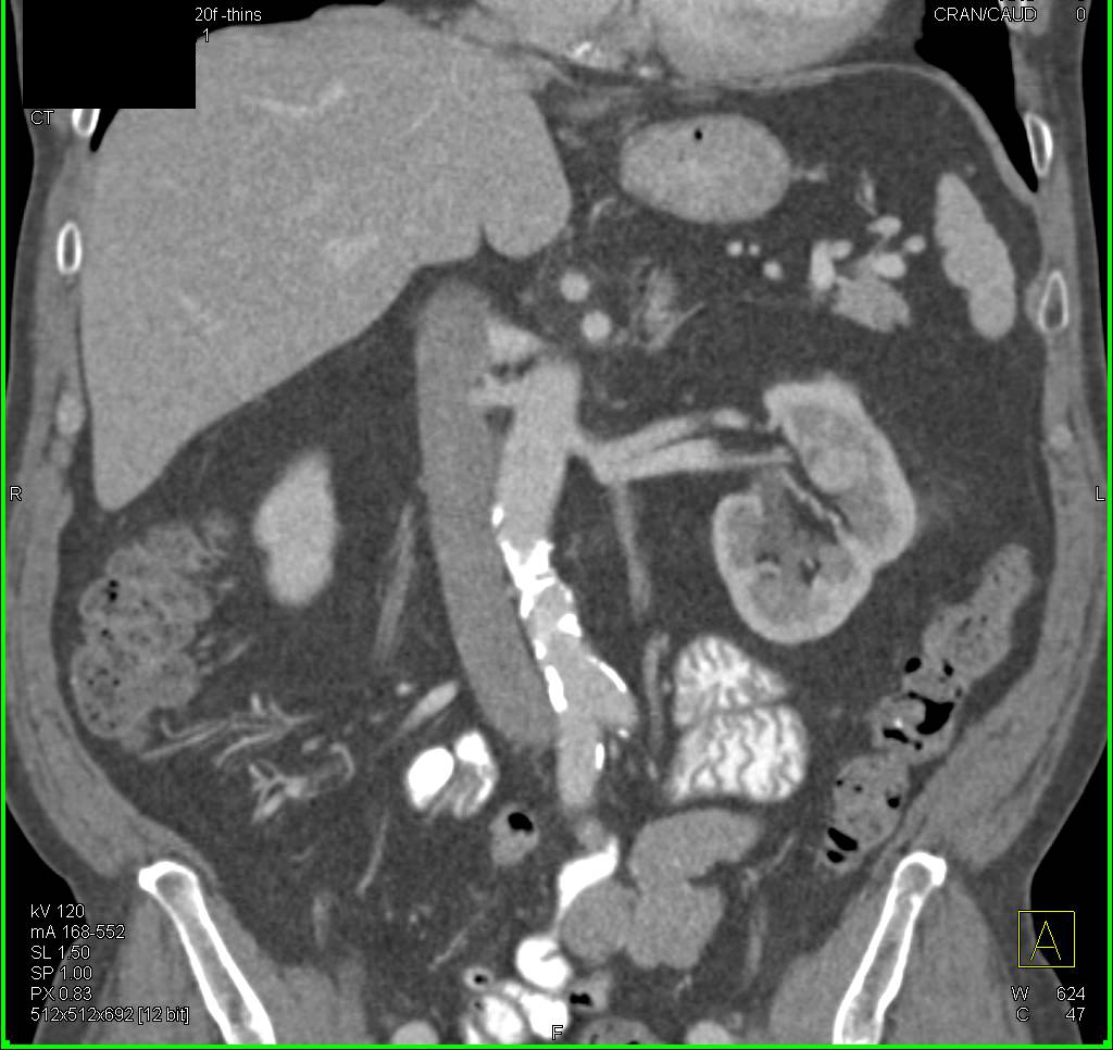 Subtle 1cm Left Renal Cell Carcinoma - CTisus CT Scan