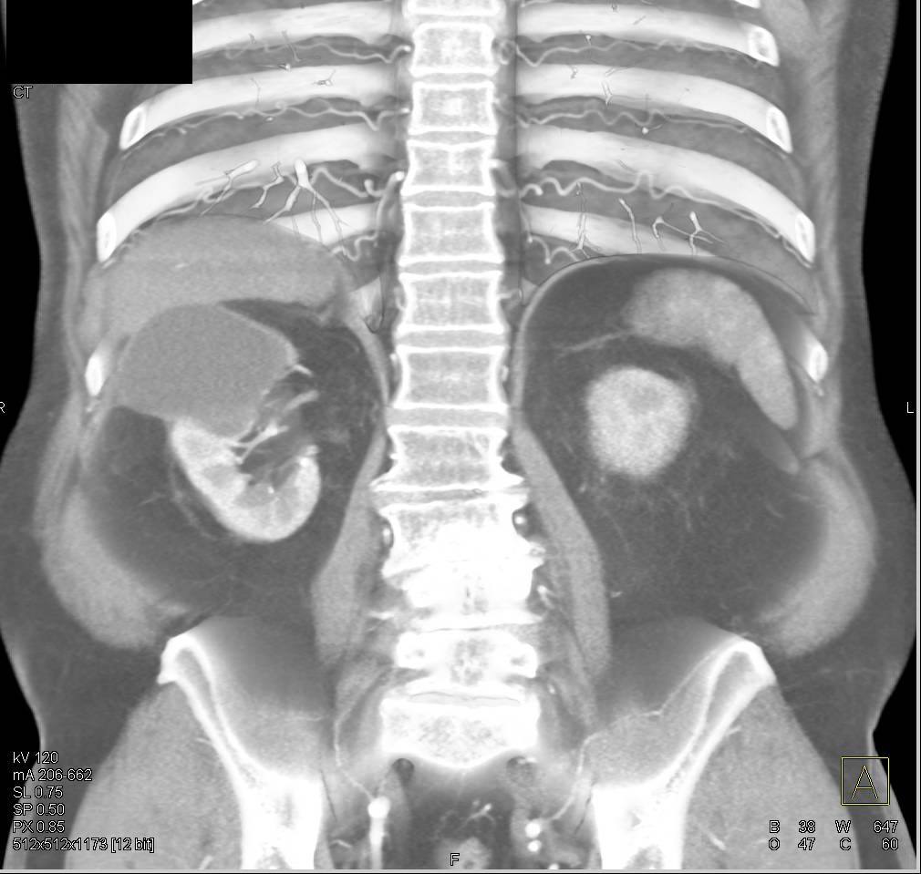 Bosniak 2F Cyst Right Kidney - CTisus CT Scan