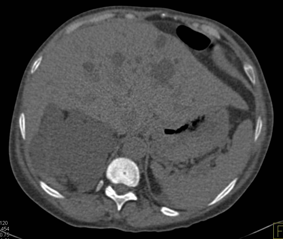 Polycystic Kidney Disease with Hemorrhagic Cysts - Kidney Case Studies ...