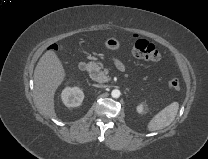 Subtle Stone in Distal Common Bile Duct seen best on MPR - CTisus CT Scan