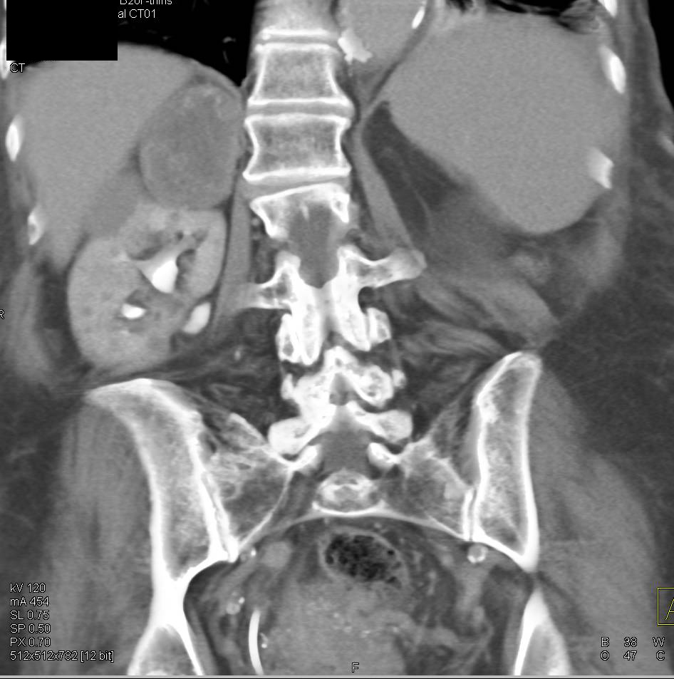 Old Right Adrenal Hematoma and Renal Cystic Disease Left Kidney - CTisus CT Scan