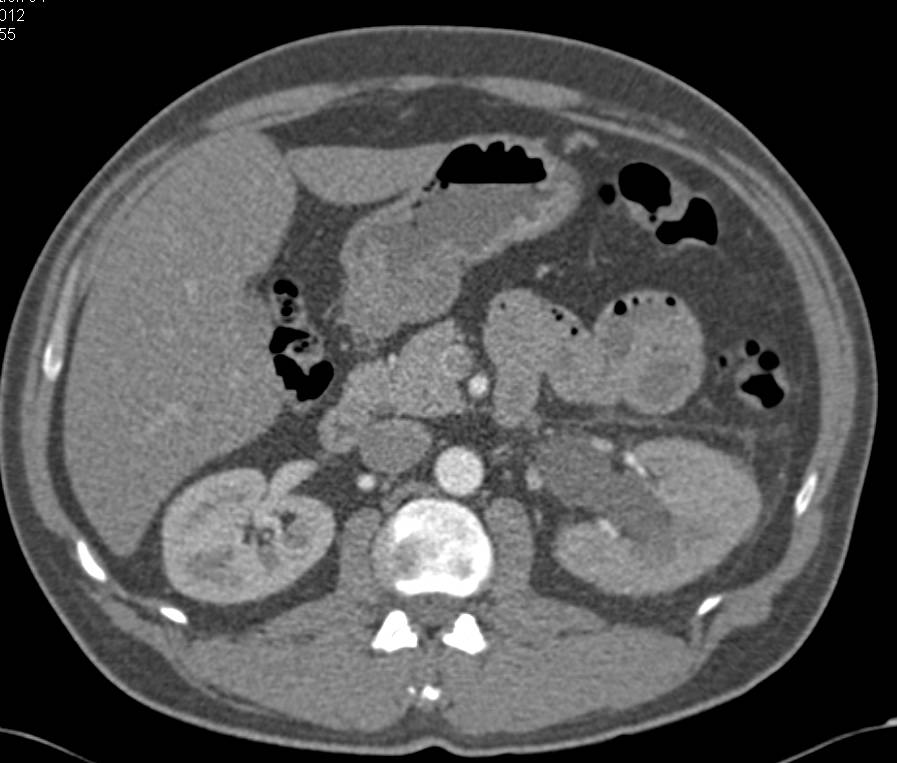 Left Hydronephrosis due to a Stone in the Distal Left Ureter - CTisus CT Scan