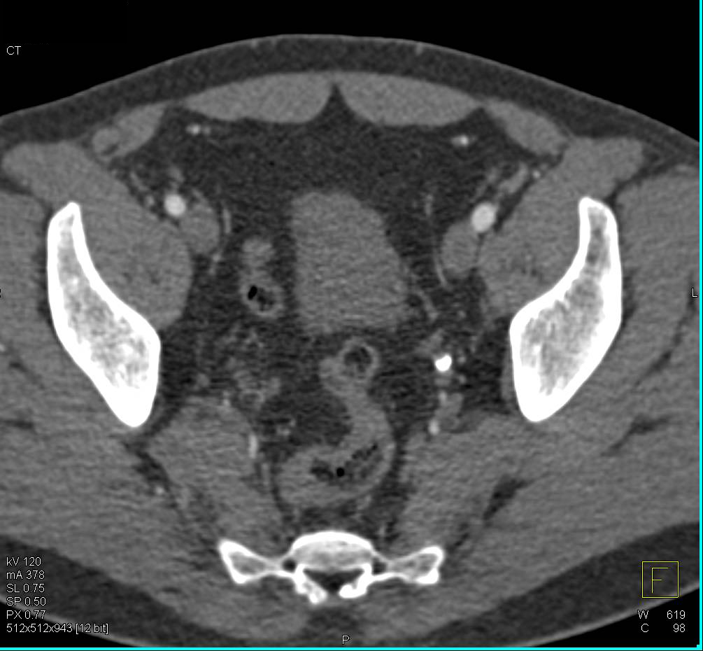 Obstructing Stone in the Distal Left Ureter - CTisus CT Scan