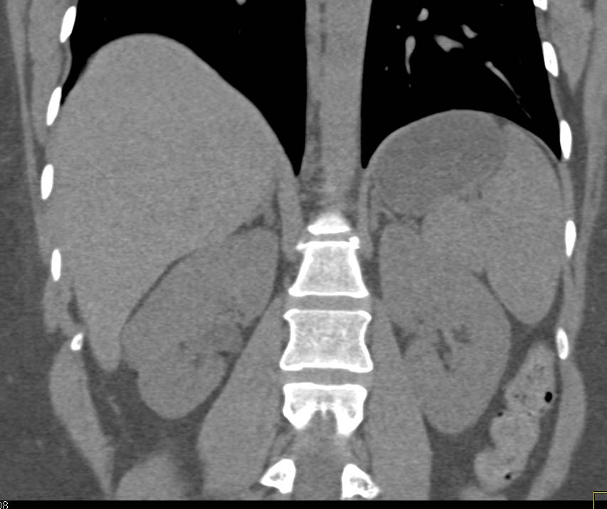 Acute Pyelonephritis - Kidney Case Studies - CTisus CT Scanning