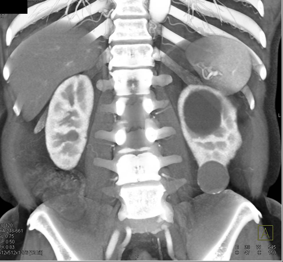 Bosniak 2F Cyst Lower Pole Left Kidney - CTisus CT Scan