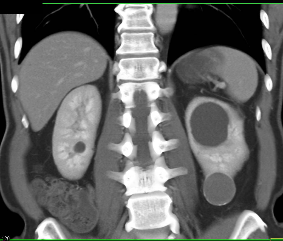 Bosniak 2F Cyst Lower Pole Left Kidney - Kidney Case 