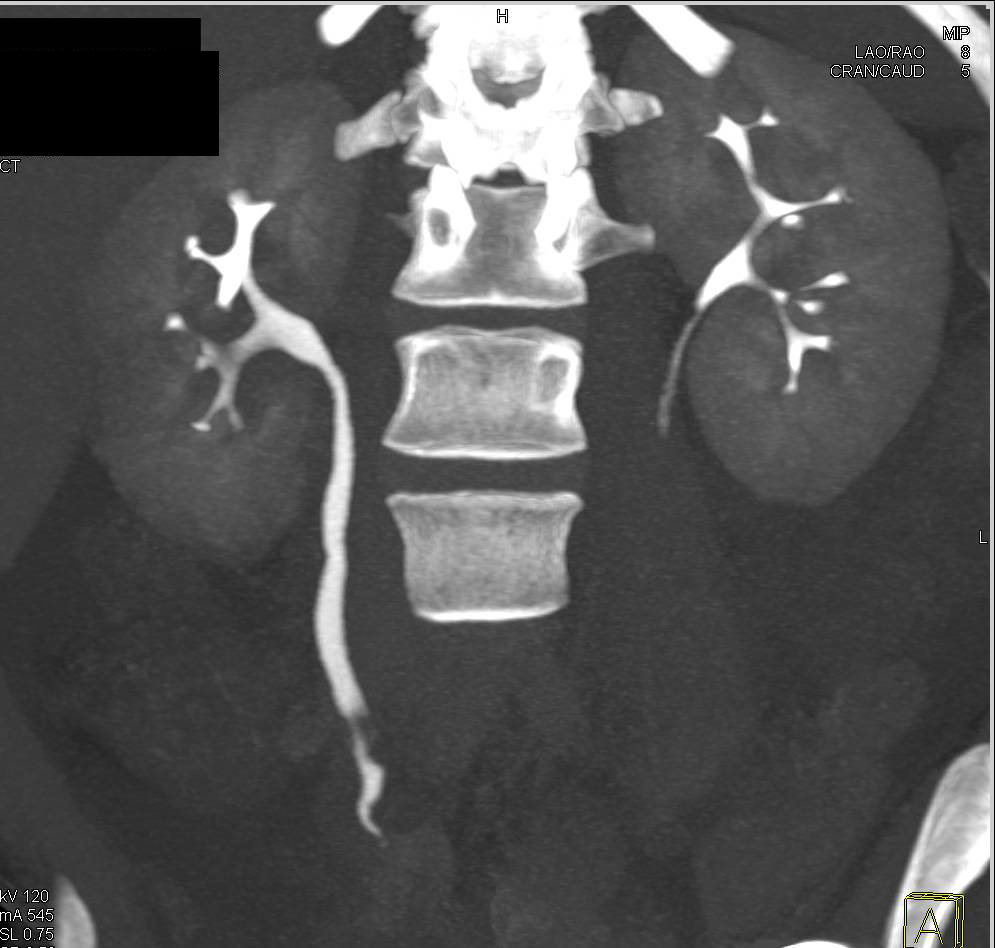 Transitional Cell Carcinoma of the Right Ureter - CTisus CT Scan