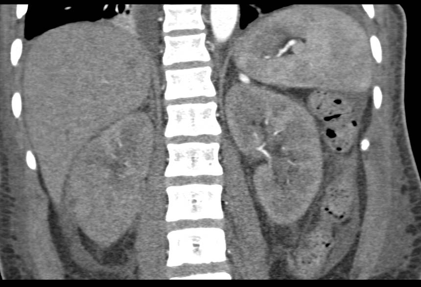 Renal Abscess with Lack of Some Function of the Kidney - CTisus CT Scan