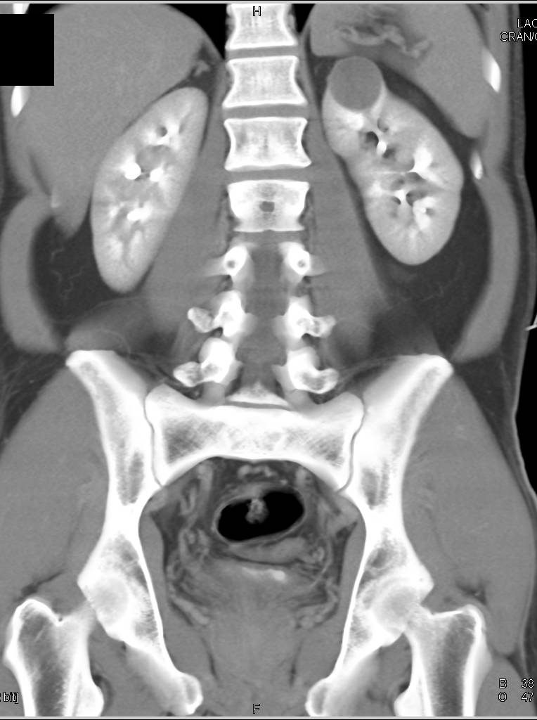 High Density Cyst Upper Pole Left Kidney - Kidney Case Studies - CTisus ...