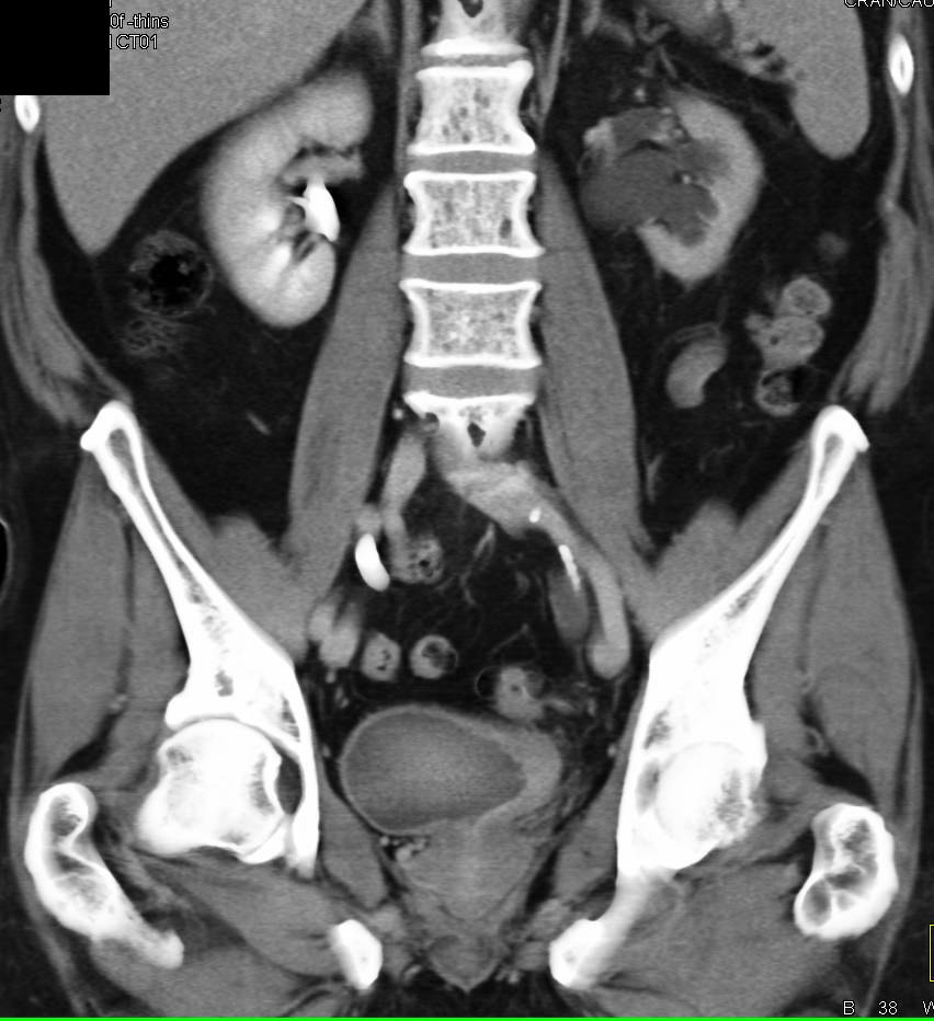 Obstructed Left Kidney due to Bladder Cancer - CTisus CT Scan