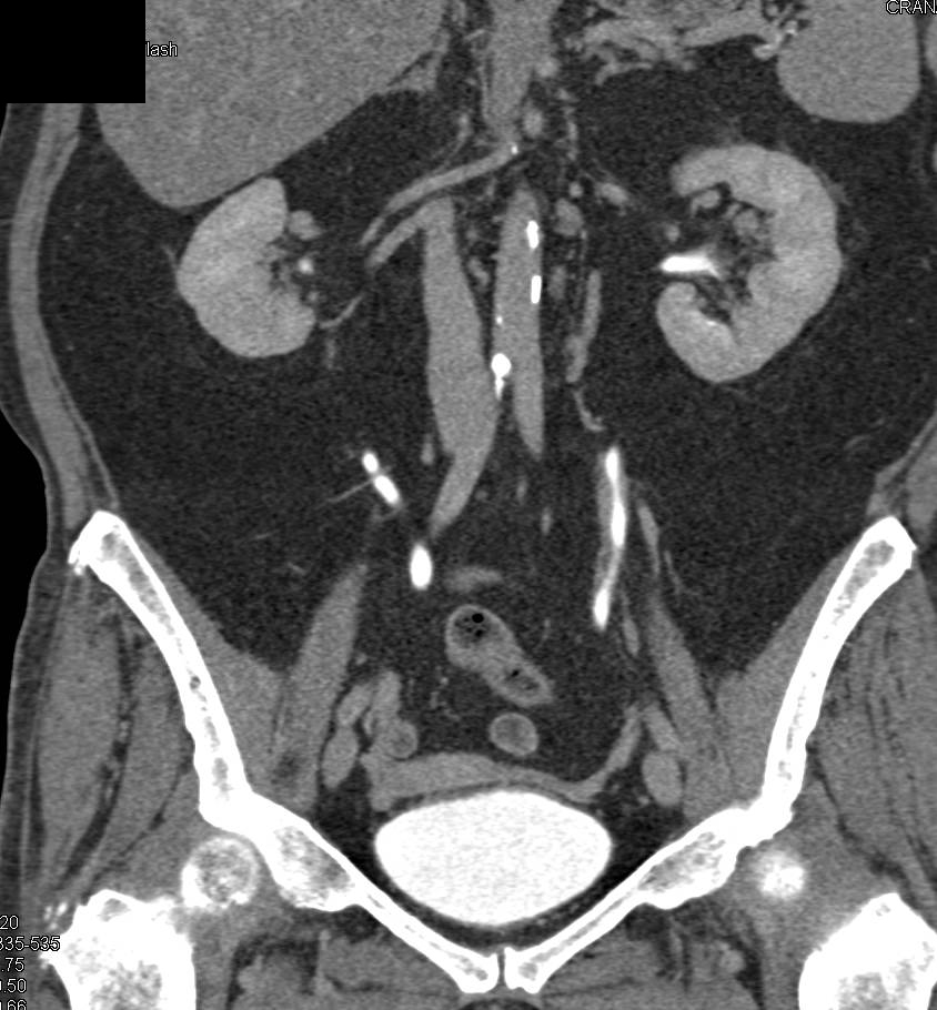 Transitional Cell Carcinoma Left Ureter - CTisus CT Scan