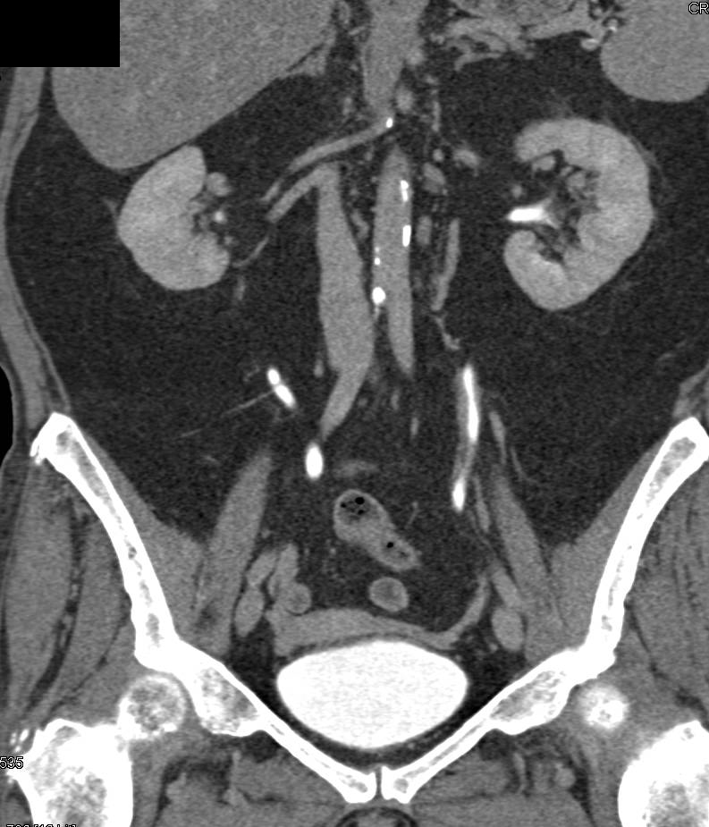 Transitional Cell Carcinoma of the Left Ureter - CTisus CT Scan